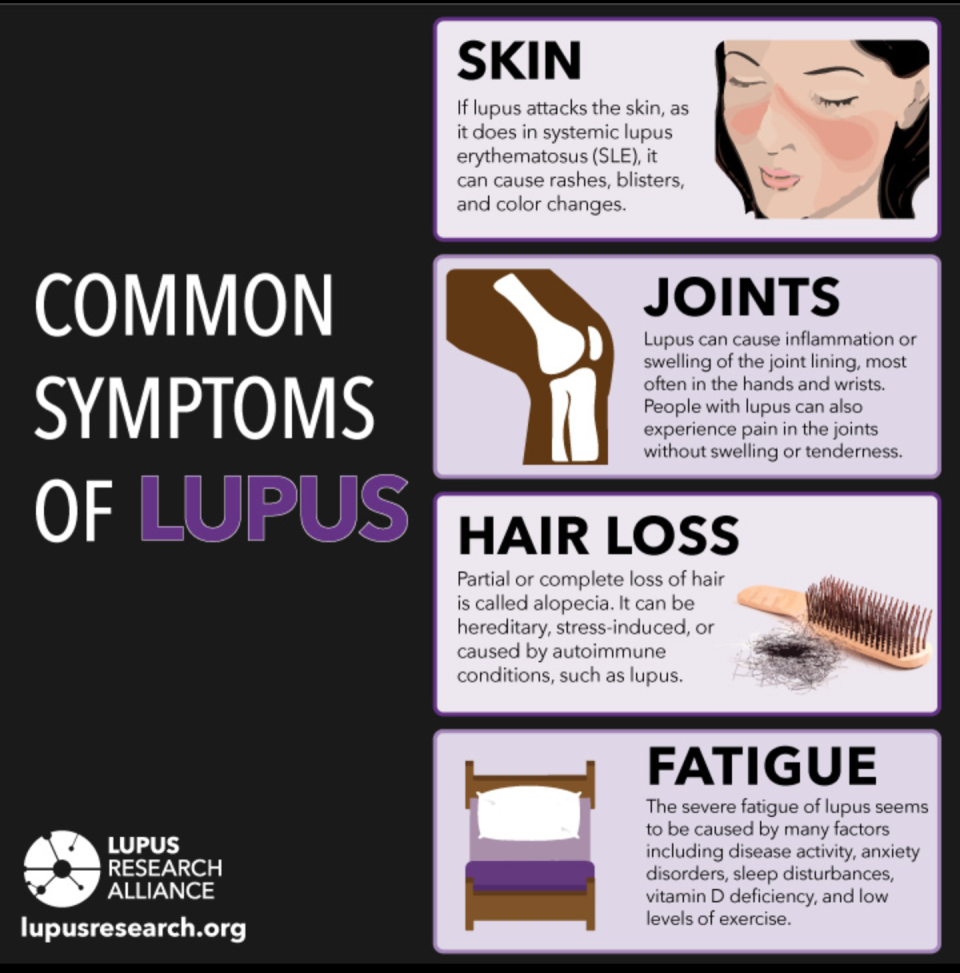 Lupus Awareness: But What Is Lupus? – LMS Digital News